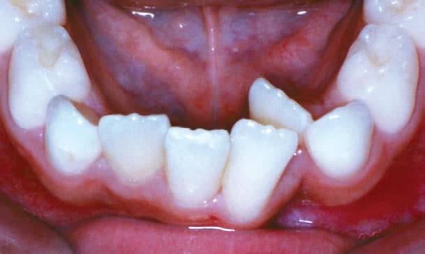 Crowding Mattioli Orthodontics in East Greenwich, RI