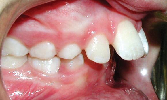 Protrusion Mattioli Orthodontics in East Greenwich, RI