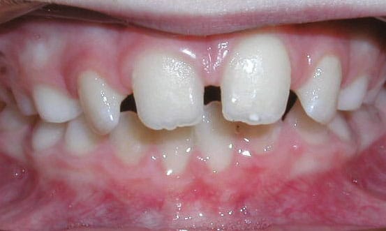 Spacing Mattioli Orthodontics in East Greenwich, RI