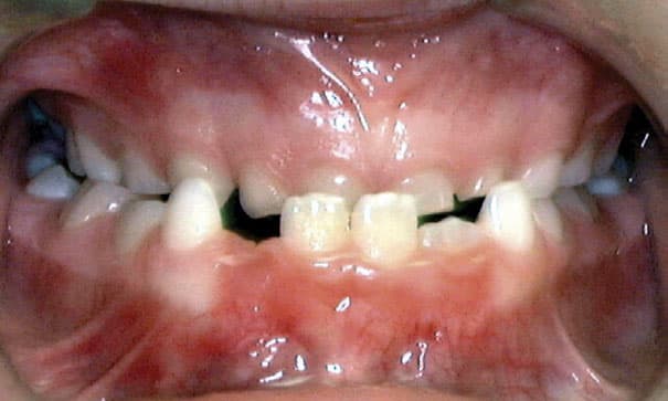 Underbite Mattioli Orthodontics in East Greenwich, RI