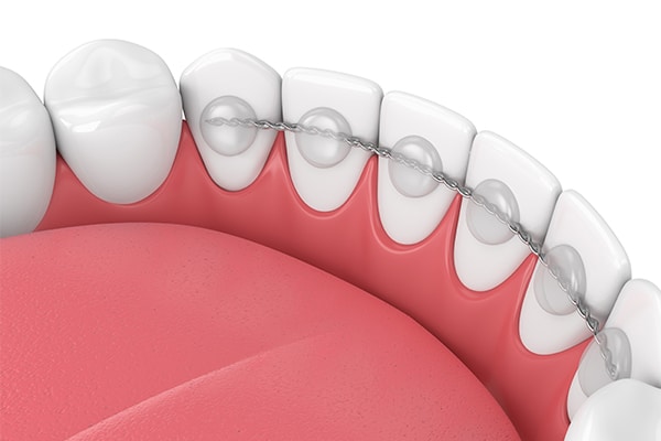 Fixed Retainers Mattioli Orthodontics in East Greenwich, RI